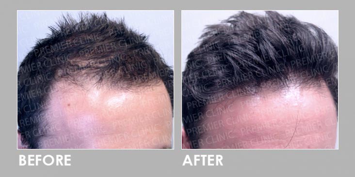 Before & After Finasteride Oral & Regro Spray