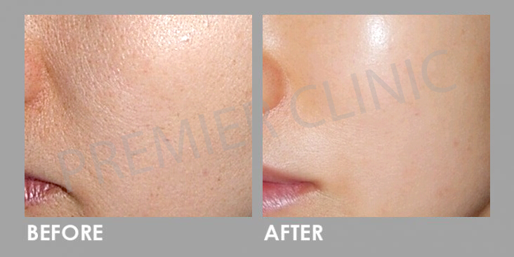 Before & After Rejuran Healer Treatment