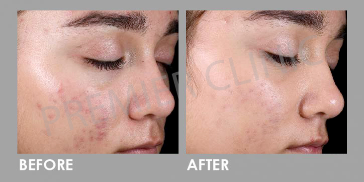 Before & After Rejuran Healer Treatment