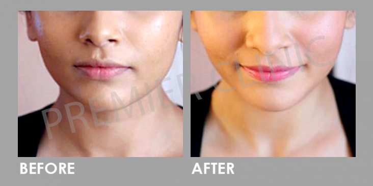 Before & After Rejuran Healer Treatment