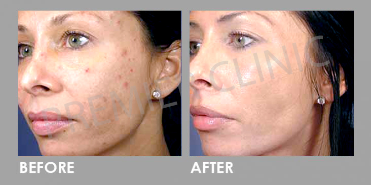 Before & After Rejuran Healer Treatment
