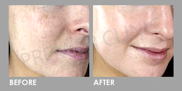 Before & After Rejuran Healer Treatment