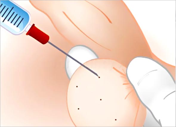 Scrotum Botulinum Toxin