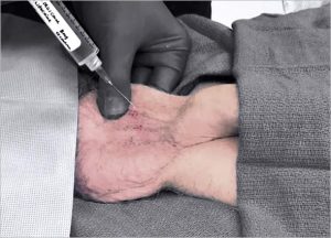 Scrotum Botulinum Toxin