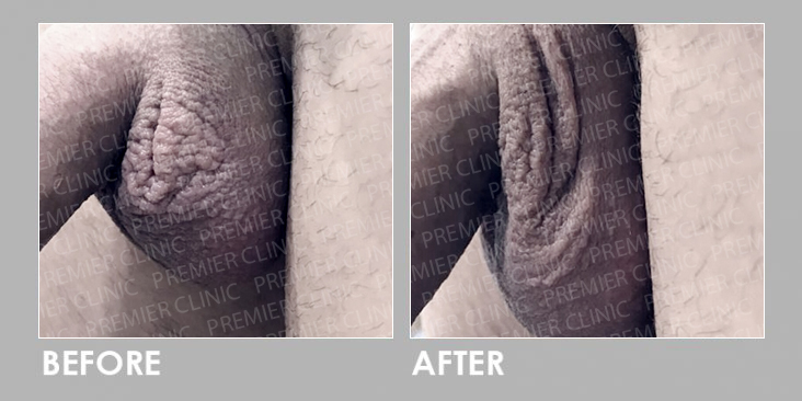 Before & After Scrotum Botulinum Toxin