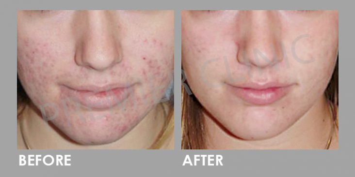 Before & After Silkpeel Dermalinfusion