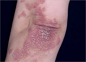Skin Fungal Infection Laser