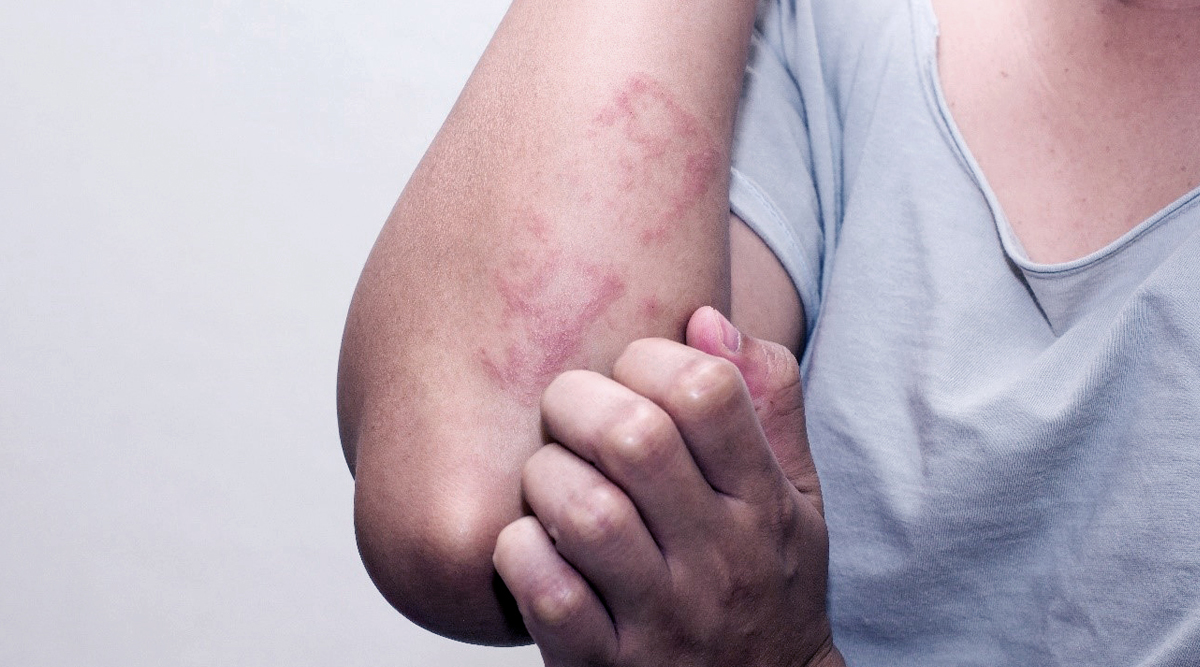 Skin Fungal Infection Laser