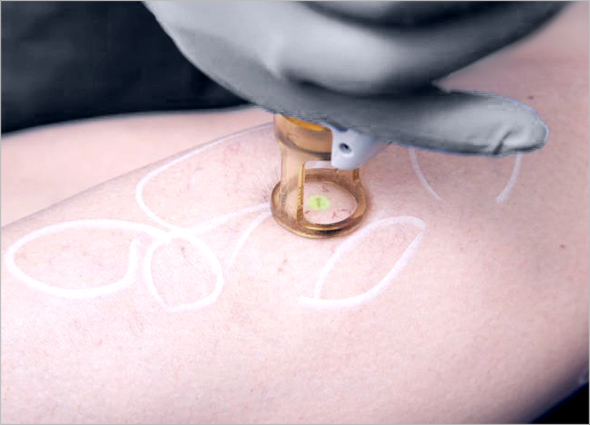 Skin Fungal Infection Laser