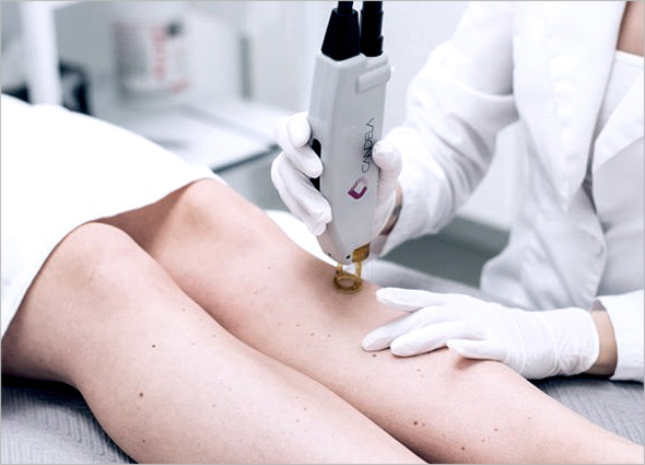Skin Fungal Infection Laser