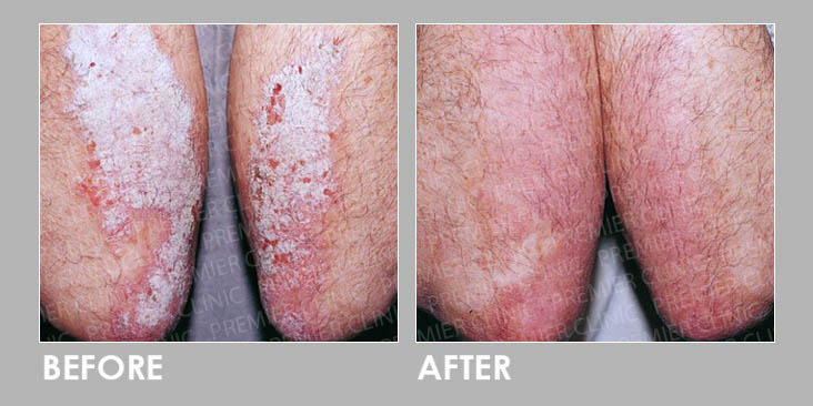Before & After Skin Fungal Infection Laser