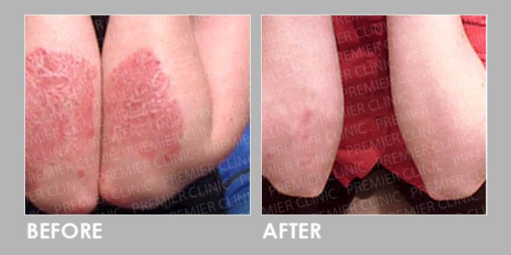 Before & After Skin Fungal Infection Laser