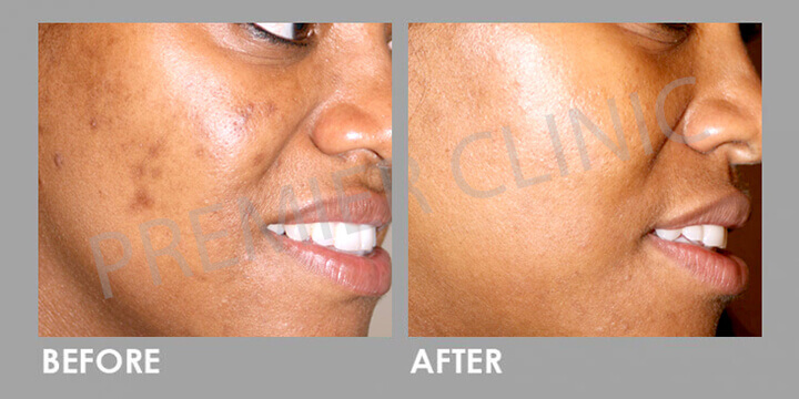 Skin Peel - Before & After 01