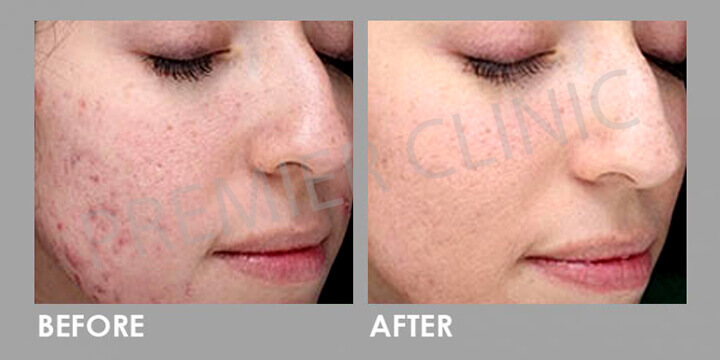 Skin Peel - Before & After 02