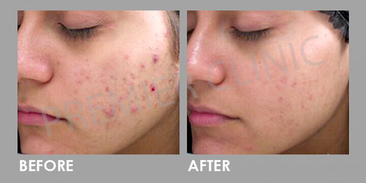 Skin Peel - Before & After 03