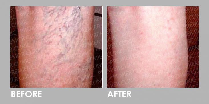 Spider Veins