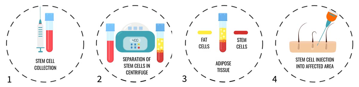 Stem Cell Hair Treatment