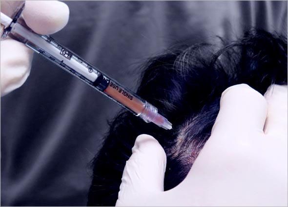 Stem Cell Hair Treatment