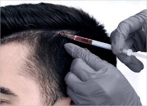 Stem Cell Hair Treatment