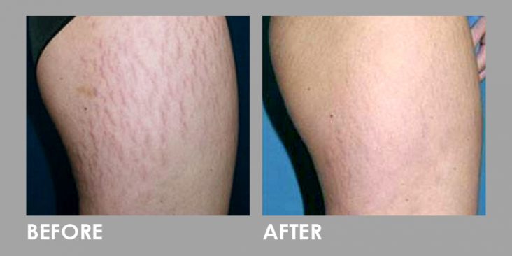 StretchMarks_Before After