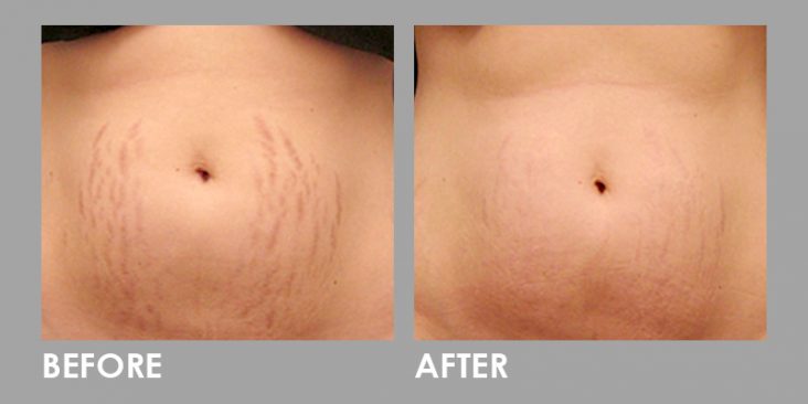 StretchMarks