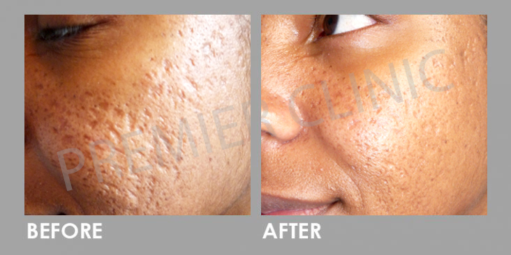 Before & After Subcision Skin Resurfacing Treatment