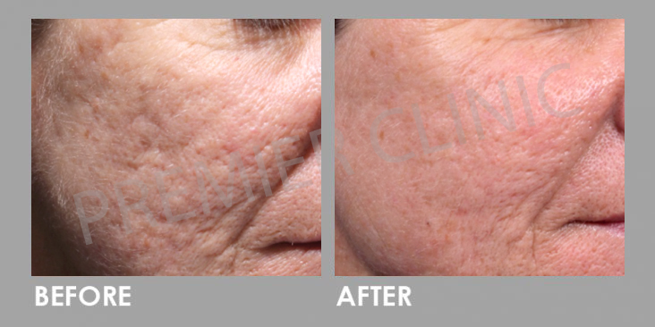 Before & After Subcision Skin Resurfacing Treatment