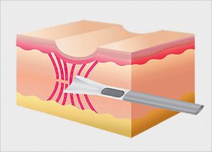 Subcision Skin Resurfacing Treatment