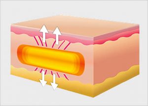 Subcision Skin Resurfacing Treatment