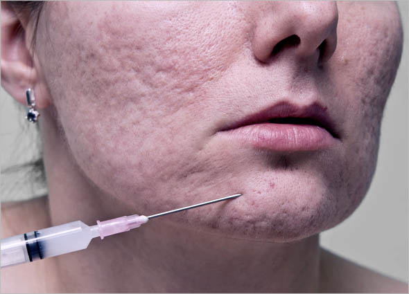 Subcision Skin Resurfacing Treatment