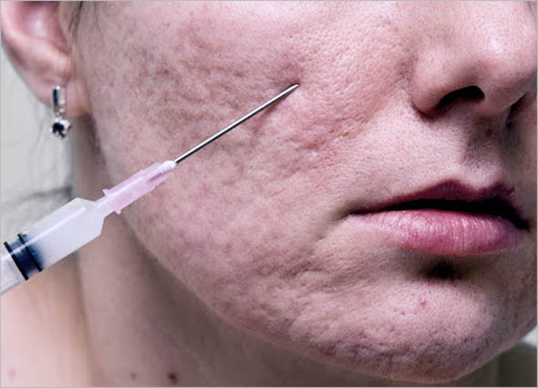 Subcision Skin Resurfacing Treatment