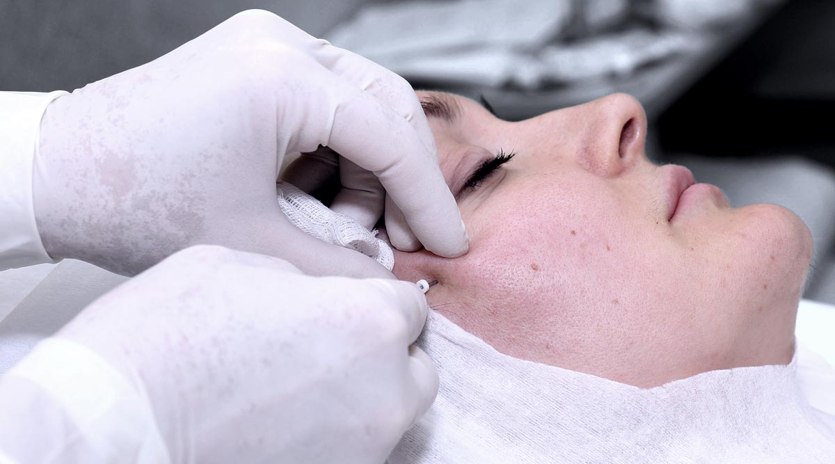 Subcision Skin Resurfacing Treatment