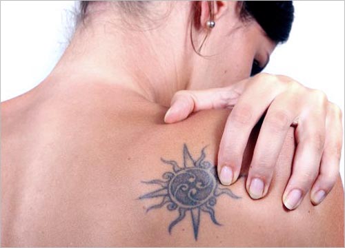 Tattoo removal