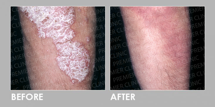 UVB Therapy Before & After