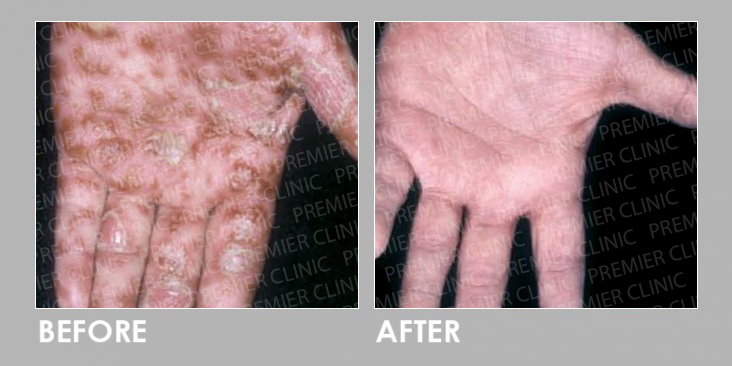 UVB Therapy Before & After