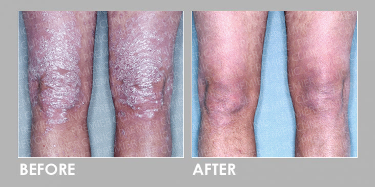 UVB Therapy Before & After