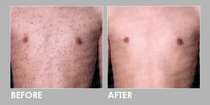 UVB Therapy Before & After