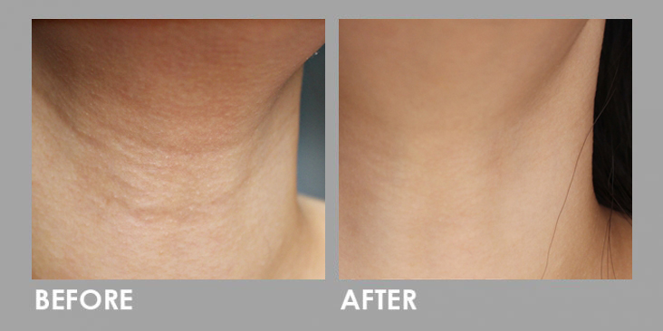 Ultherapy High Intensity Focused Ultrasound