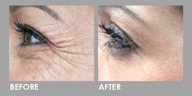 Ultherapy High Intensity Focused Ultrasound