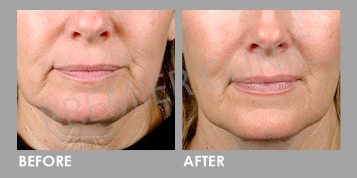 Ultherapy High Intensity Focused Ultrasound