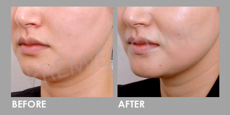 Ultherapy High Intensity Focused Ultrasound