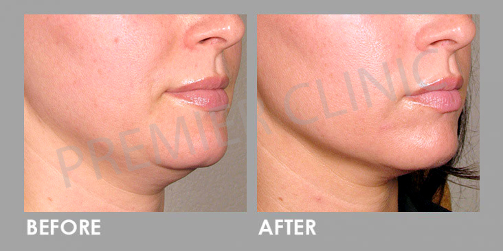 Ultherapy High Intensity Focused Ultrasound