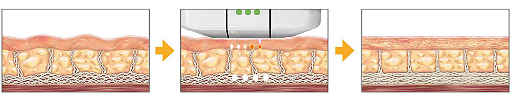 Ultherapy High Intensify Focused Ultrasound (HIFU)
