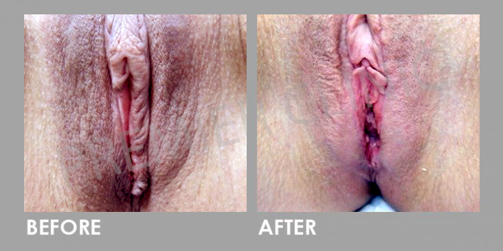 Female Genitals Skin Whitening Laser Treatment