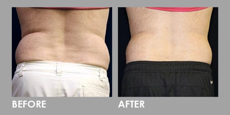 Before & After Vanquish Fat Removal Treatment