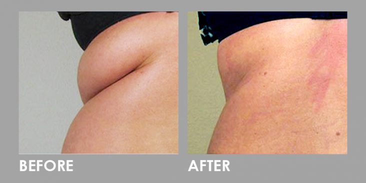 Before & After Vanquish Fat Removal Treatment