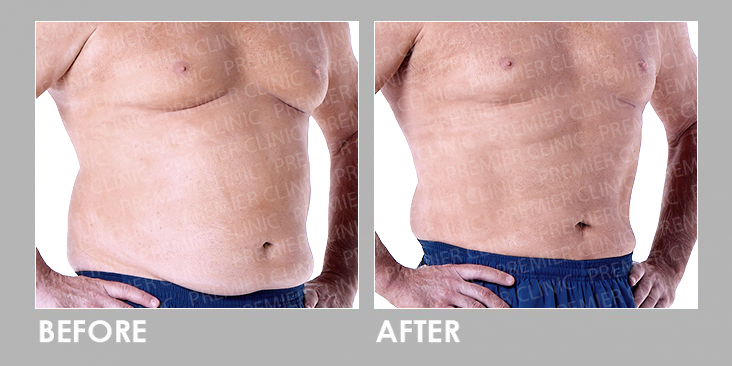Before & After Oral Weight Loss Slimming Pills