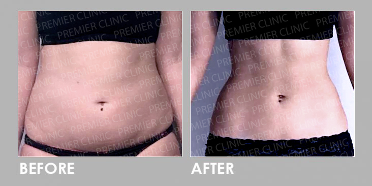 Before & After Oral Weight Loss Slimming Pills