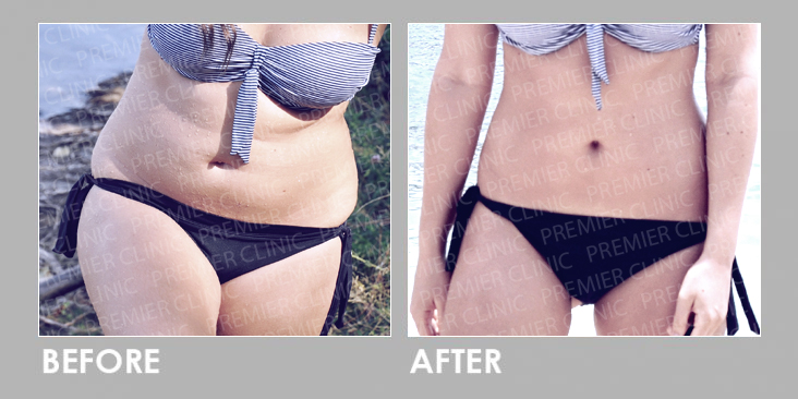 Before & After Oral Weight Loss Slimming Pills