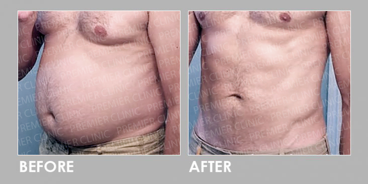Before & After Oral Weight Loss Slimming Pills